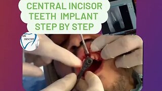 Central incisor teeth implant #viral #video #Dental implants