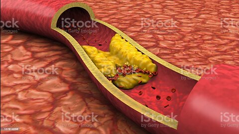 Cholesterol control [ tip's ] Reduce bad cholesterol [ and improve good cholesterol ]