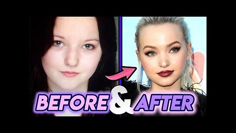 Dove Cameron | Before and After Transformations | Complete Plastic Surgery Procedures!