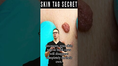 How To Remove Skin Tags FOREVER! [Skin Tag Removal Secret]
