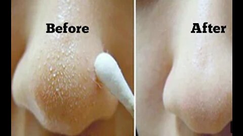 How to Get Rid of Blackheads & Whiteheads At Home