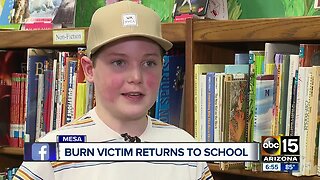 Burn victim returns to school for first time after accident