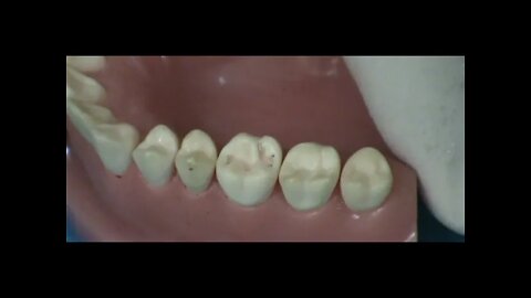 Class I Occlusal Surface Upper First Molar