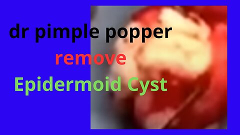 dr pimple popper remove Epidermoid Cyst #dr #pimple #popper #remove