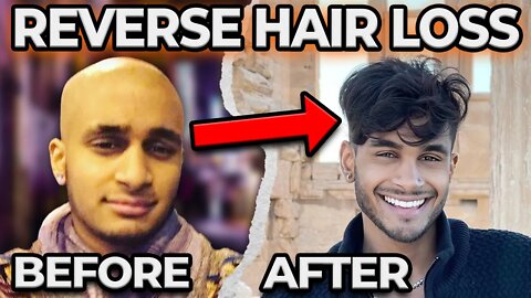 How I Reversed My Hair Loss (STOP BALDING)