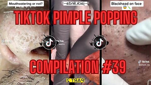 How'd He Get Soooo Many Blackheads | TikTok Pimple Popping Compilation - EP#39