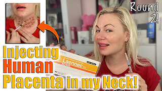 Injecting Human Placenta in my Neck, Round 2 from AceCosm.com | Code Jessica10 Saves you Money $$$