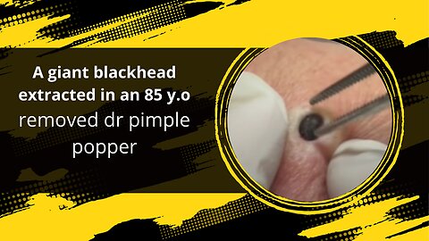 giant blackhead extracted in an 85 y.o remove dr pimple popper