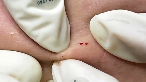 Big Blackhead Removal/Extraction with Hana Spa - Dr Pimple Popper