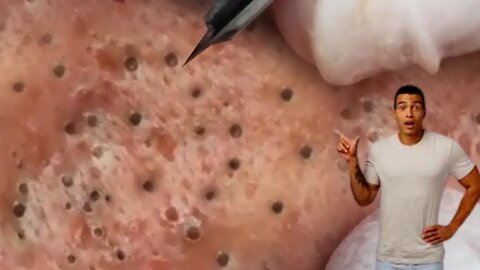 Vídeo Satisfatório de Cravo e Espinhas Espremendo Cravos e Espinhas Gigantes Black heads Pimple