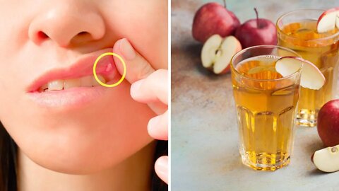 See How an Apple Can Get Rid of Your Canker Sores Naturally