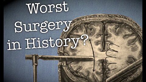 The Dark side of Science: The Lobotomy, the worst surgery in history?
