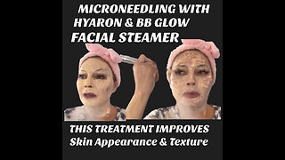 Microneedling With Hyaron and BB Glow New Facial Steamer