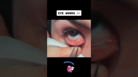 Eye worms Removal - wtf? #eyeworm #blackheadsremoval #pimple