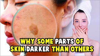 WHY SOME PARTS OF SKIN DARKER THAN OTHERS