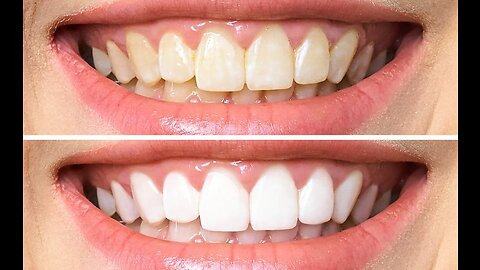 How to make your Teeth White