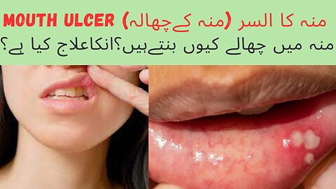 Mouth Ulcer (منہ کےچھالہ ) , cause and treatment. منہ میں چھالے کیوں بنتےہیں؟انکاعلاج کیا ہے؟