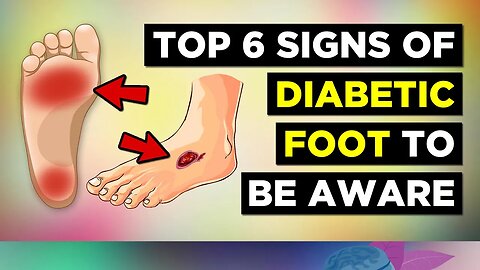 6 Early Signs of Diabetic Foot