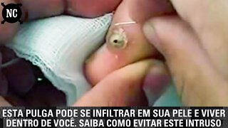 Esta pulga pode se infiltrar em sua pele e viver dentro de você. Saiba como evitar este intruso