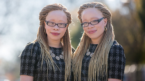 Twins With Albinism Wear Their Condition With Style | SHAKE MY BEAUTY