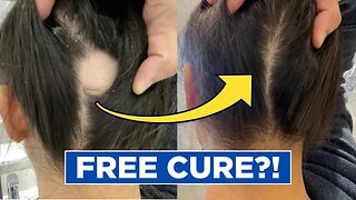 Hair Loss Cure 2022?!... AND IT'S COMPLETELY FREE!!!