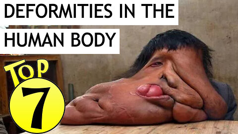 Top 07 Deformities in the human body