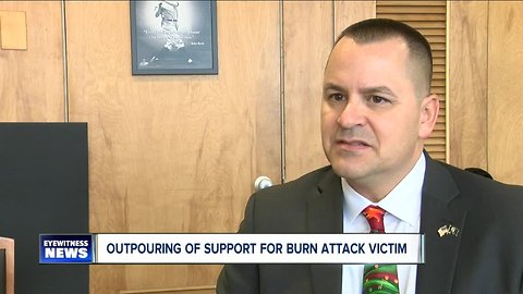 Outpouring of support for burn attack victim