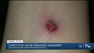 Mom pulls son from school after she says she found cigarette burn on his arm