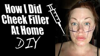 Old Video - First Time Cheek Filler at Home, Code Jessica10 Saves you Money