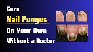 5 Ways To Cure Nail Fungus At Home