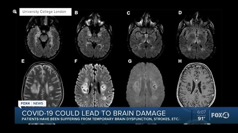 Scientists say coronavirus could lead to brain damage