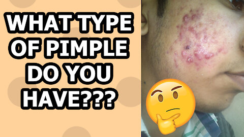 The 6 Types Of Pimples You Need To Know!