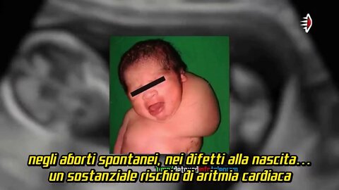 Morti fetali intrauterine e malformazioni in madri vaccinate - dal film documentario DIED SUDDENLY