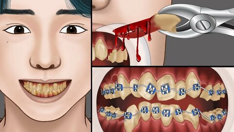 ASMR changes in teeth when treated tooth - brace | Satisfied dental treatment