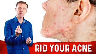 How To Get Rid Of Acne Fast? Try Dr.Berg's Home Remedies For Acne