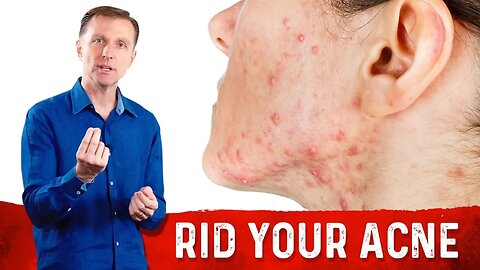 How To Get Rid Of Acne Fast? Try Dr.Berg's Home Remedies For Acne