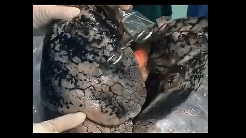 Shocking Images of Blackened Lungs from Chain Smoker - A Wake-Up Call for Smokers!