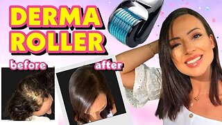 DIY TREATMENT DERMA ROLLER FOR HAIR LOSS + MIRACLE SECRET CURE!
