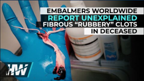 EMBALMERS WORLDWIDE REPORT UNEXPLAINED FIBROUS “RUBBERY” CLOTS IN DECEASED