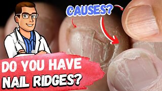 🖐Do you have Vertical Nail Ridges? [Causes & Treatment]🖐