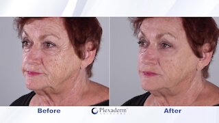 You're NEVER too old to look younger with Plexaderm