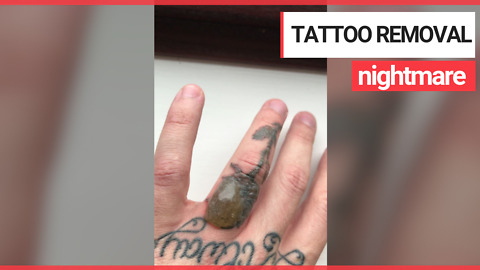Man develops huge blister on finger after second session of laser tattoo removal