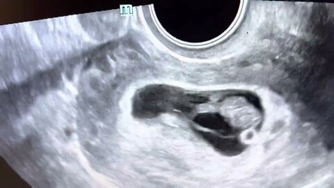 Take a Peek! Ultrasound of a triple sac pregnancy at 8 weeks, continuing as twins!
