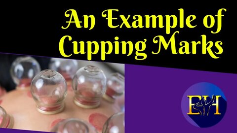 What are some examples of cupping therapy on the skin? | Tutorial: How to cup the muscles at home