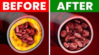 What to Eat to Clean Out Your Arteries—Dr. Berg Explains