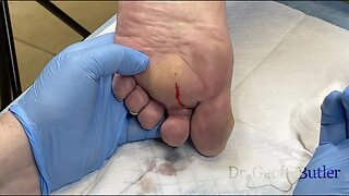 Unexpected drainage of an abscess on the foot
