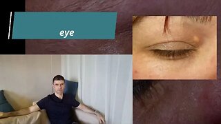 what about xanthelasma under the eye