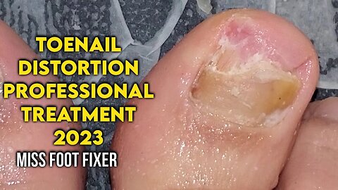 TOENAIL DISTORTION ON RIGHT FEET FULL TREATMENT BY FAMOUS PODIATRIST MISS FOOT FIXER