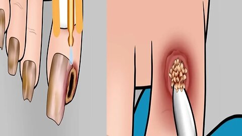ASMR Ingrown Toenail Remove Treatment Animations||Foot Finger Infection ...@uttam6361