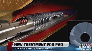 Local hospital offers a new treatment for patients with peripheral artery disease